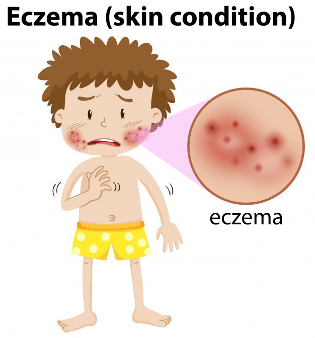 Eczema