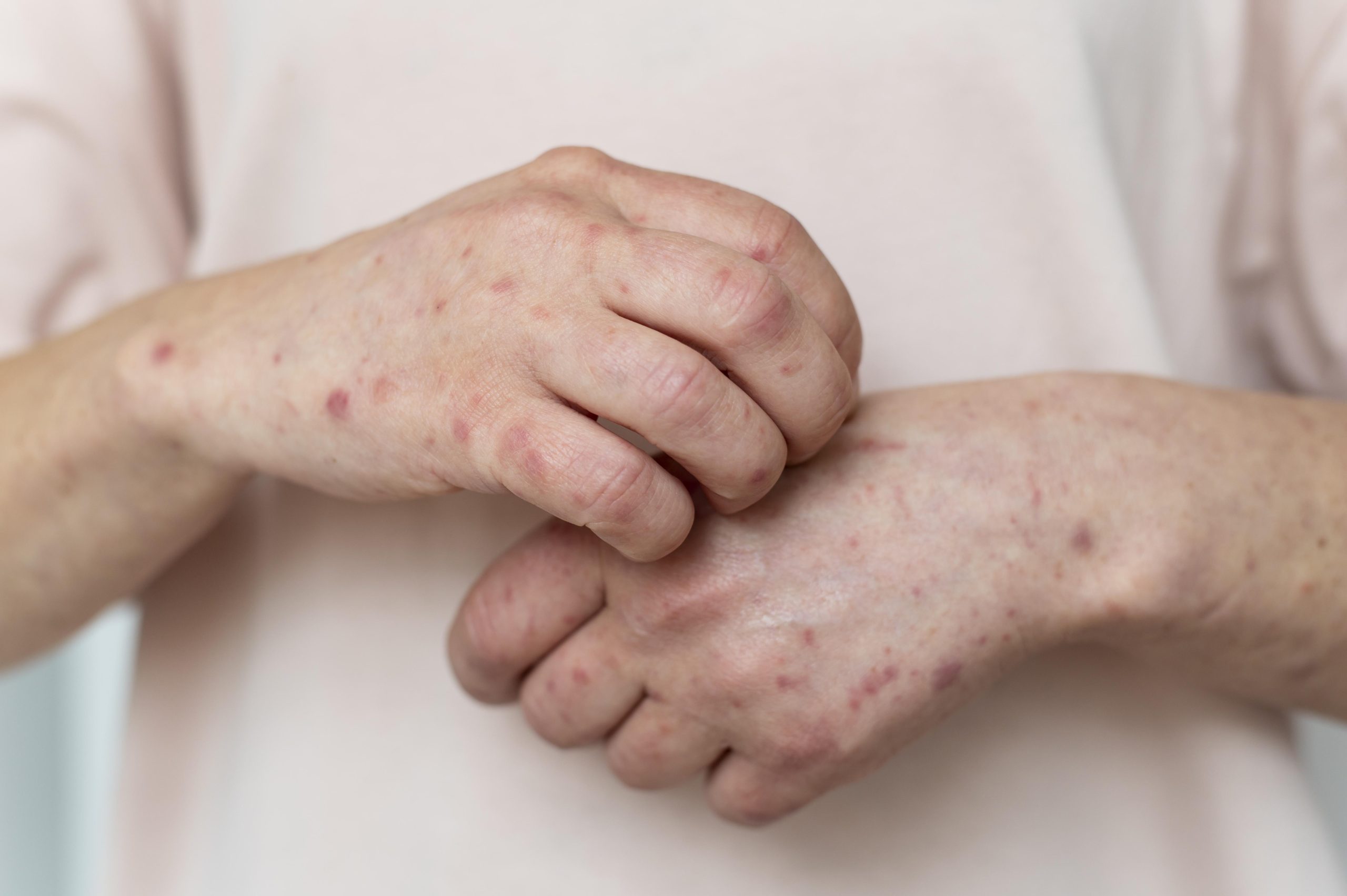 Psoriasis Doctor in Mohali
